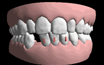 矯正牙齒后牙齒會松？矯正器表示這個黑鍋我不背