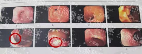 　△紅圈圈出位置為癌變部位
