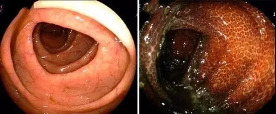 腸鏡下，正常的腸道（左）和結(jié)腸黑變病腸道對(duì)比