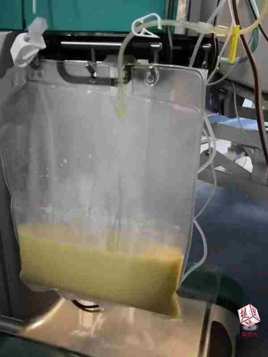 從血液中反復過濾出來的白色“脂肪液”