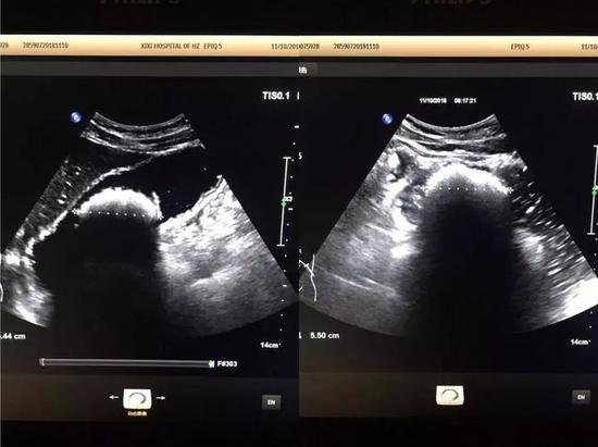 　亮亮的一團(tuán)就是胃結(jié)石