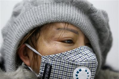 王霜（化）的太陽穴部位手術后留下凹痕