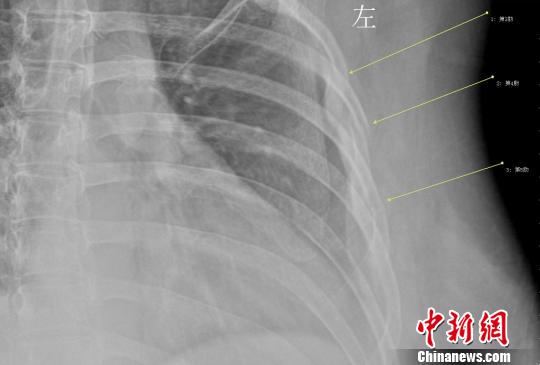 女白領咳斷3根肋骨不良生活習慣致骨質疏松