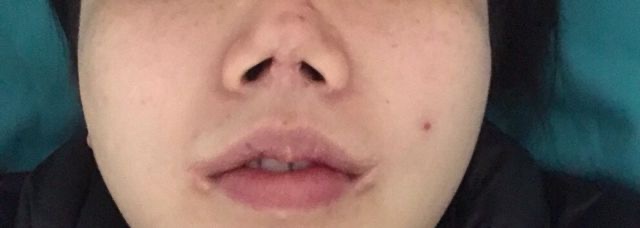 花十幾萬買來“整容噩夢”:鼻子穿孔、嘴角感染、顴骨高低不一